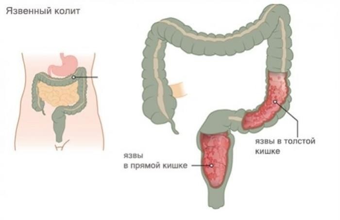 Колит и Армия