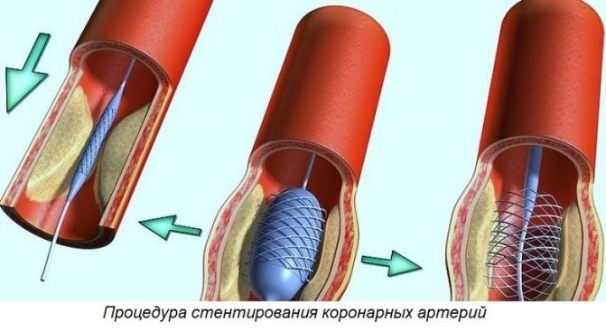 Временная утрата трудоспособности после сердечного приступа