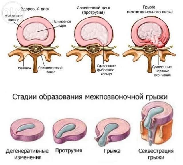 Лечение грыжи: Хирургический и нехирургический подходы