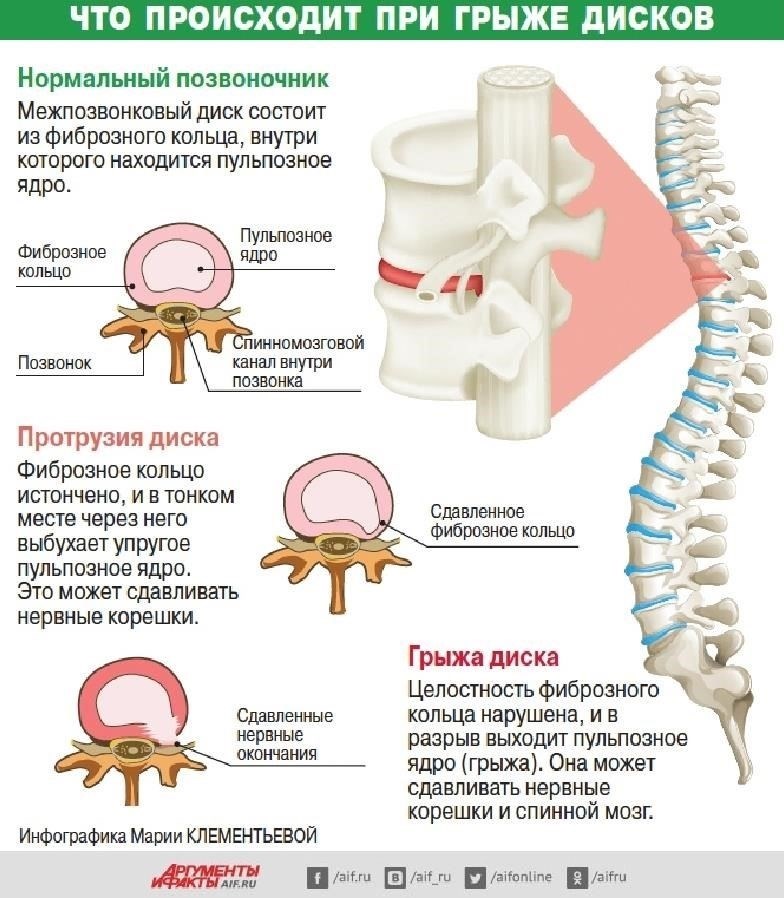 Понимание грыжи: Причины и факторы риска