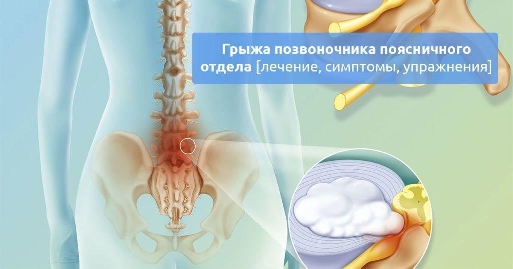 Распознавание симптомов грыжи: Когда обращаться за медицинской помощью